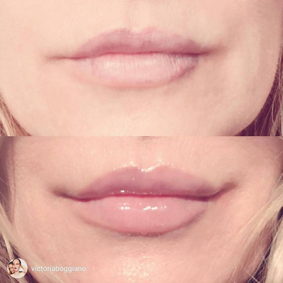 Derma rolling lips