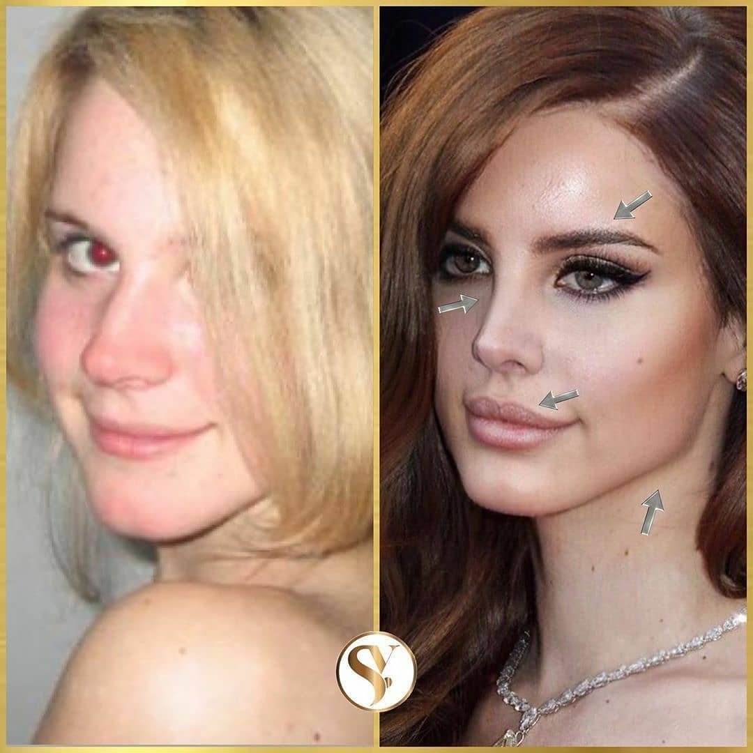 Remove Forehead Wrinkles With An Organic Shot