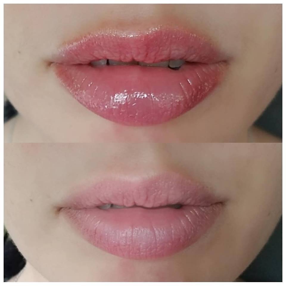 Lip wrinkle treatment