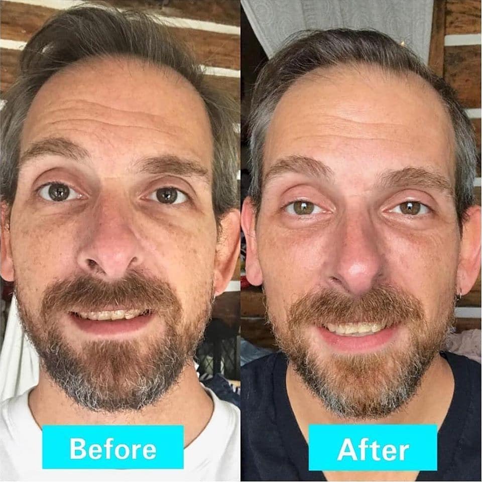 Remove Forehead Wrinkles With An Easy Skin Treatment