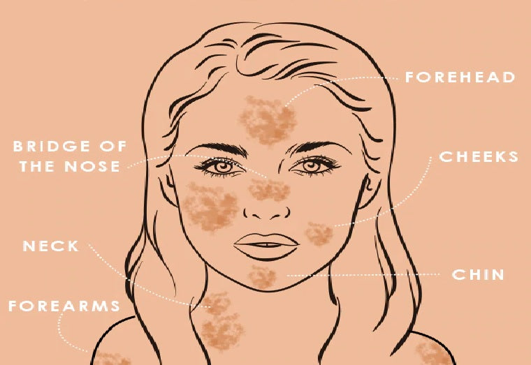 Treatment Of Melasma On Face Stunned The Industry